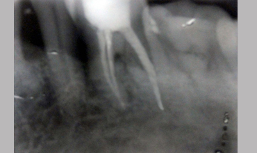 cosmetic dentistry treatment in Anand
                        